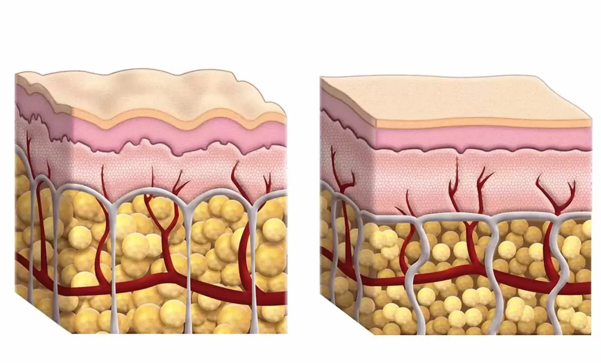 Fat cells while using Keto -Guru